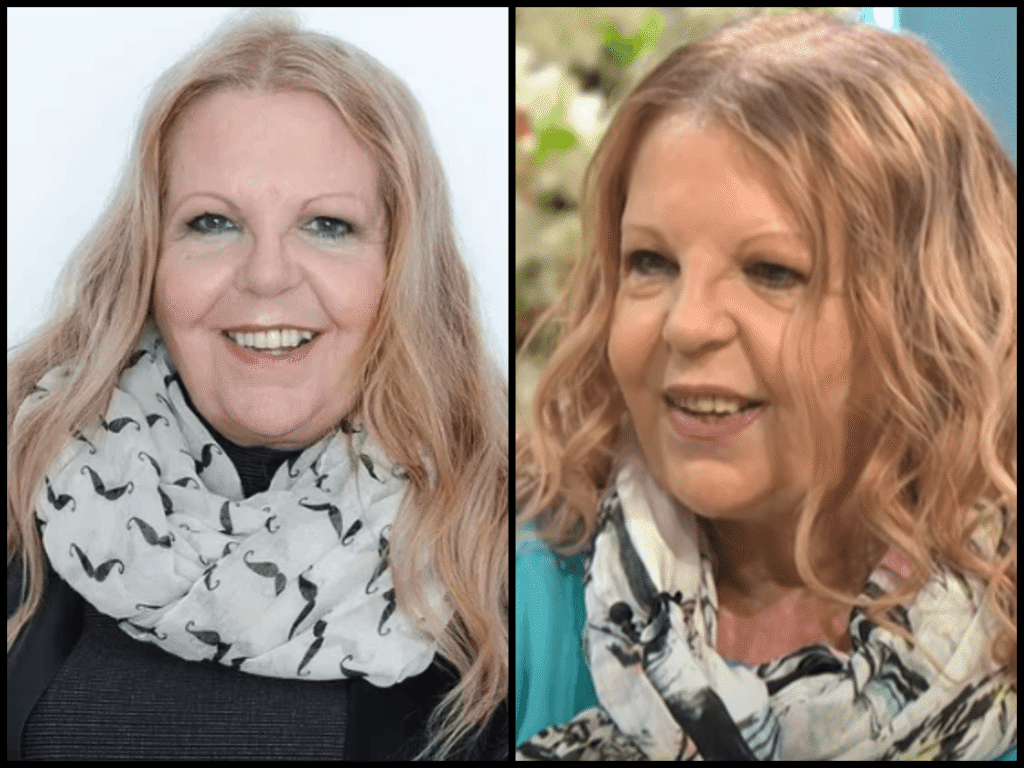 Sally Thomsett Face Illness: Facts and Appearance Speculation sally thomsett face illness